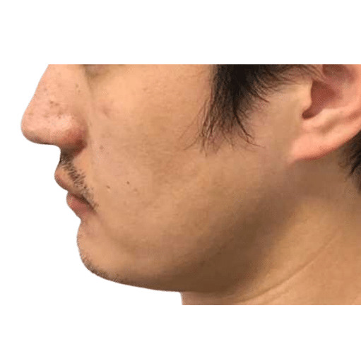 Before Image: Hair Transplant - left-side