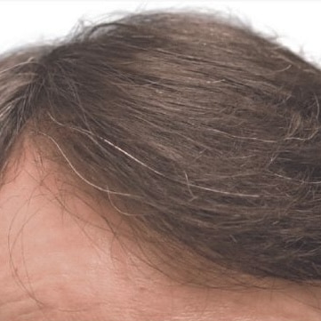 After Image: Hair Transplant - front