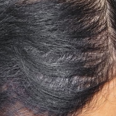 After Image: Hair Transplant - front