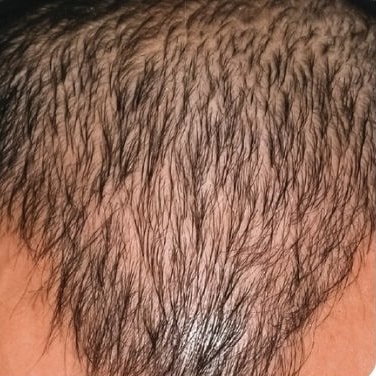 Before Image: Hair Transplant - front