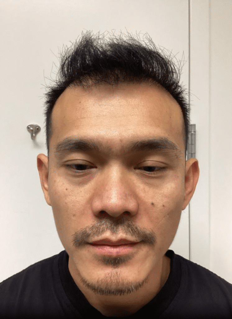After Image: Hair Transplant - front