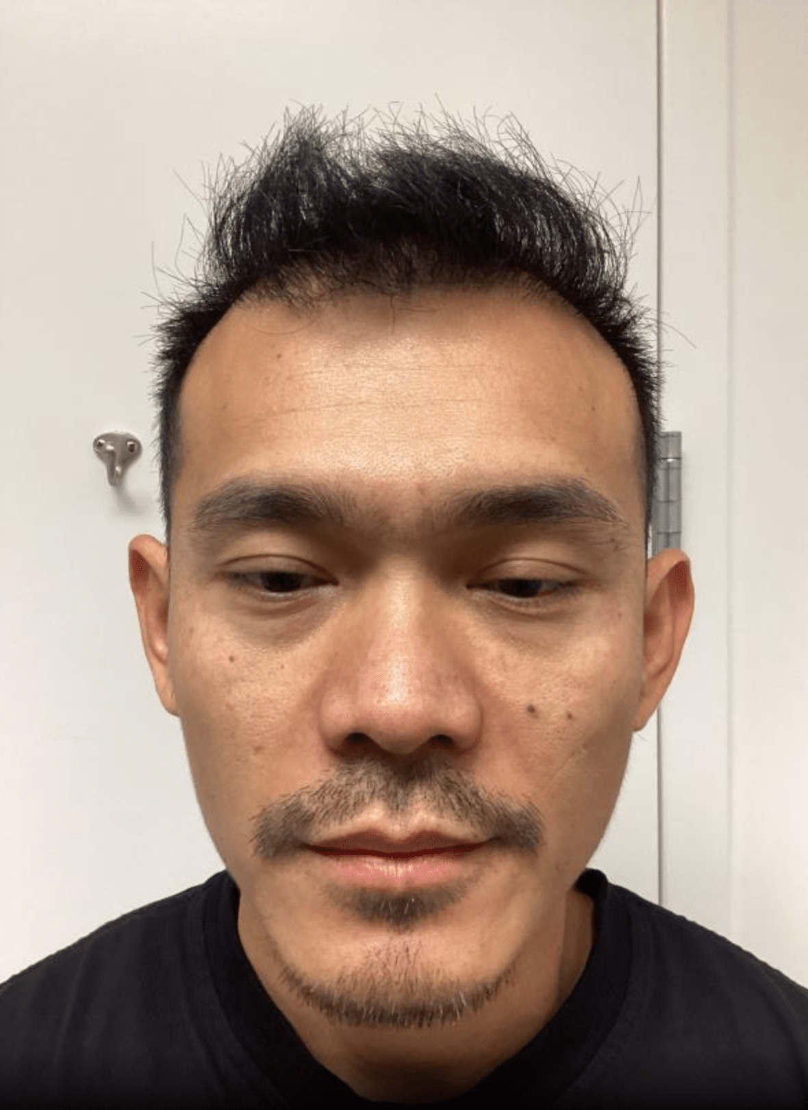 After Image: Hair Transplant - front