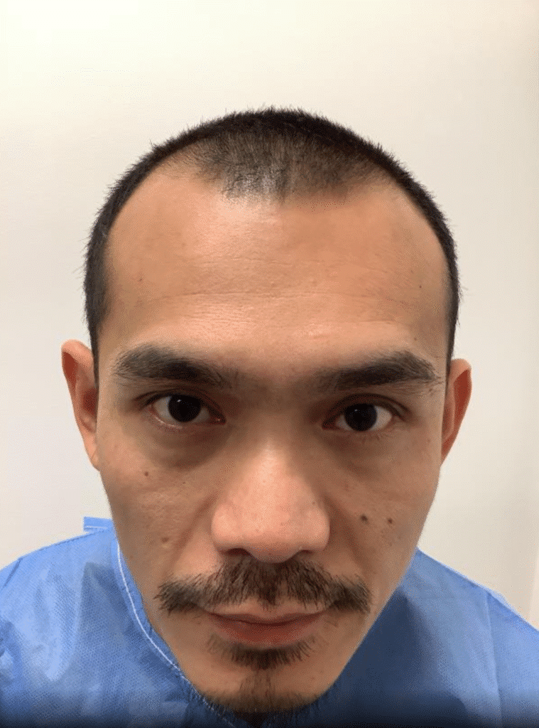 Before Image: Hair Transplant - front
