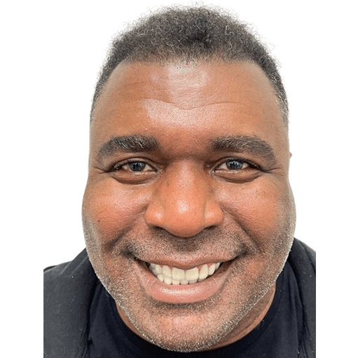 After Image: Hair Transplant - front