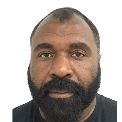 Before Image: Hair Transplant - front
