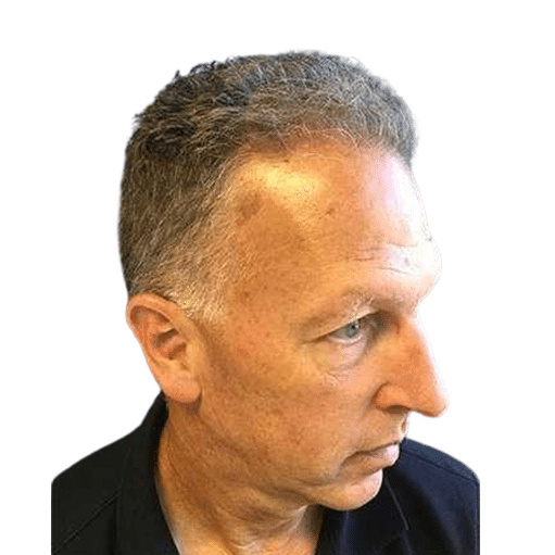 After Image: Hair Transplant - right-front-oblique