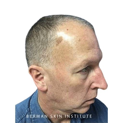 Before Image: Hair Transplant - right-front-oblique