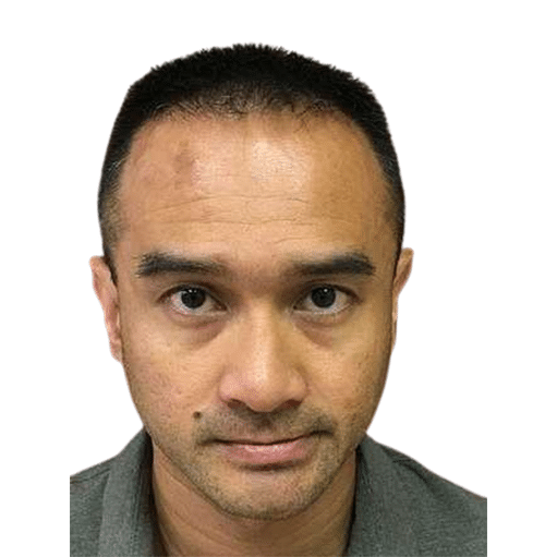 After Image: Hair Transplant - front
