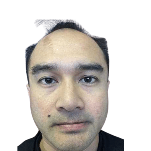 Before Image: Hair Transplant - front