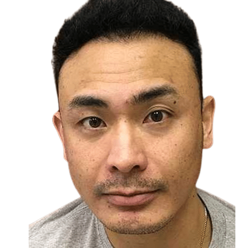 After Image: Hair Transplant - front