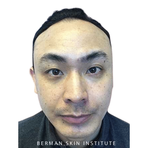 Before Image: Hair Transplant - front