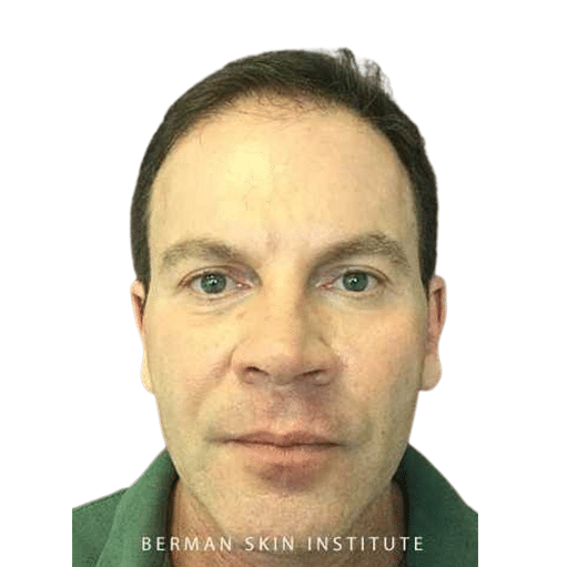 Before Image: Hair Transplant - front