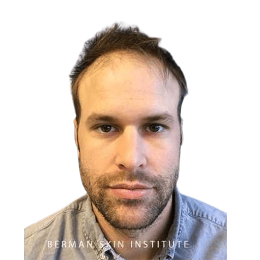 Before Image: Hair Transplant - front