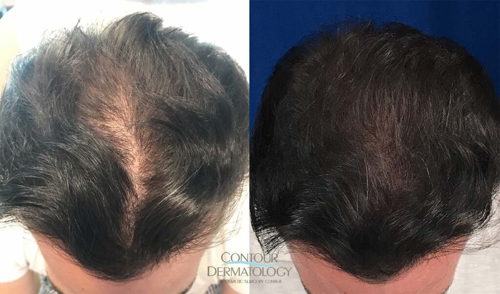 20190416-NeoGraft-Hair-Transplant-Before-After-lg (1)