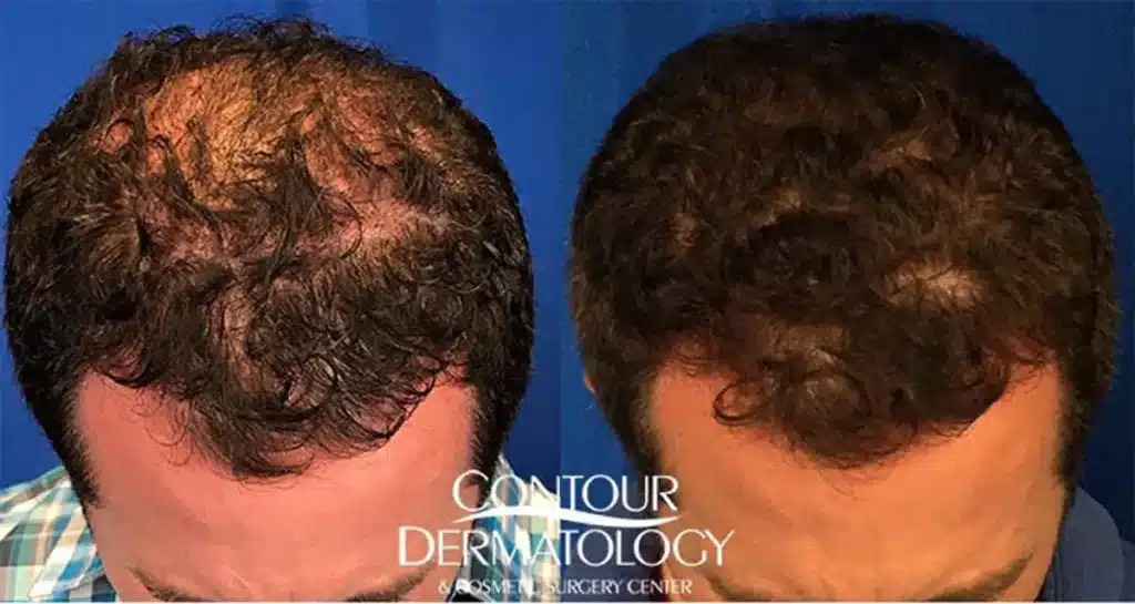 20190416-NeoGraft-Hair-Transplant-before-after-lg.jpg