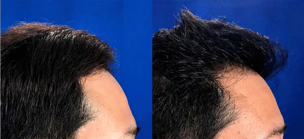 20210921-hair-transplant-lg.jpg-99afb028-a9d7-4c75-9a39-807e37b78494