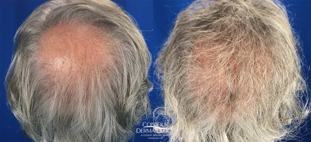 20211021-hair-transplant