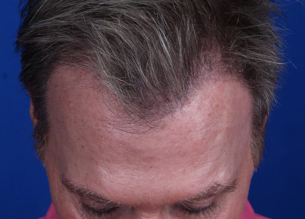 After Image: FUT Strip Graft, 1944 Grafts - front