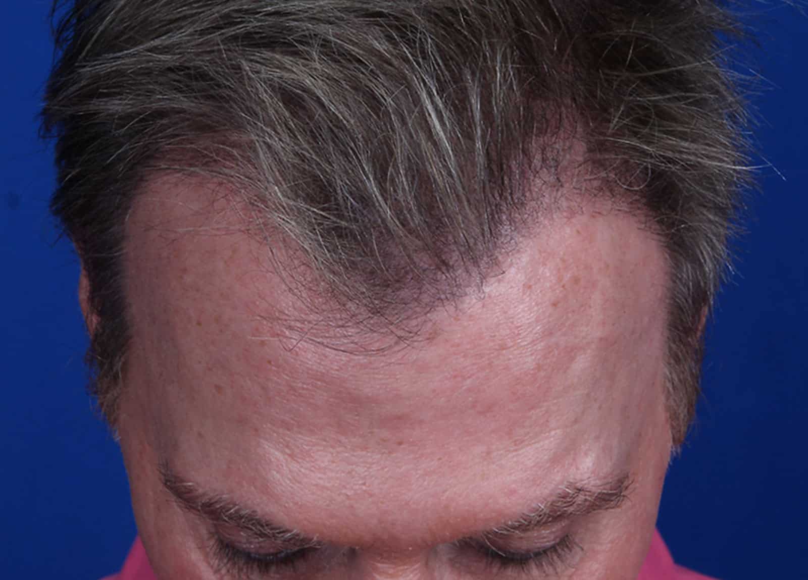 After Image: FUT Strip Graft, 1944 Grafts - front