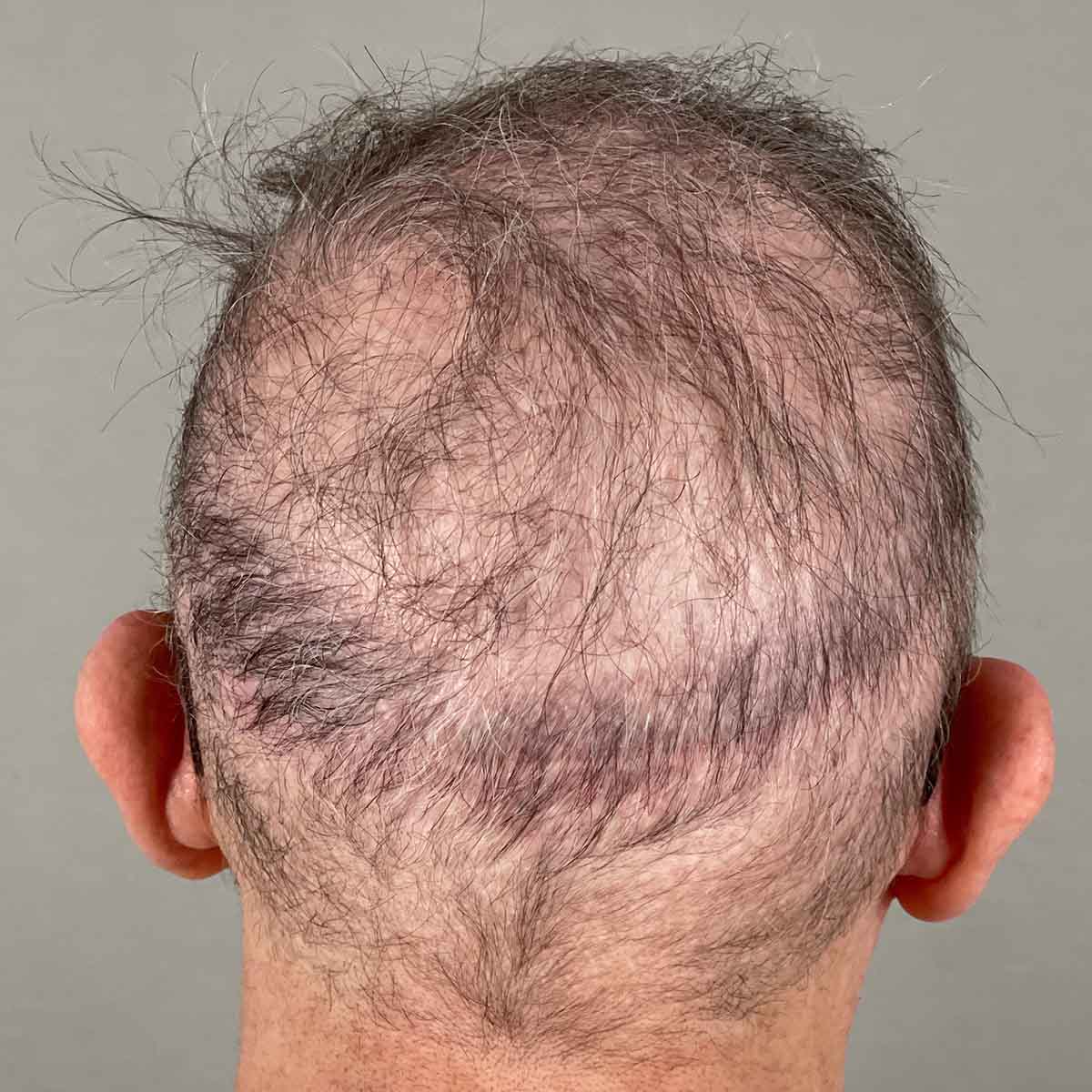 After Image: FUE Neograft, 500 grafts - back