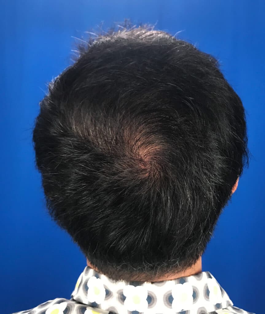 After Image: FUT Strip Graft, 2480 grafts - back