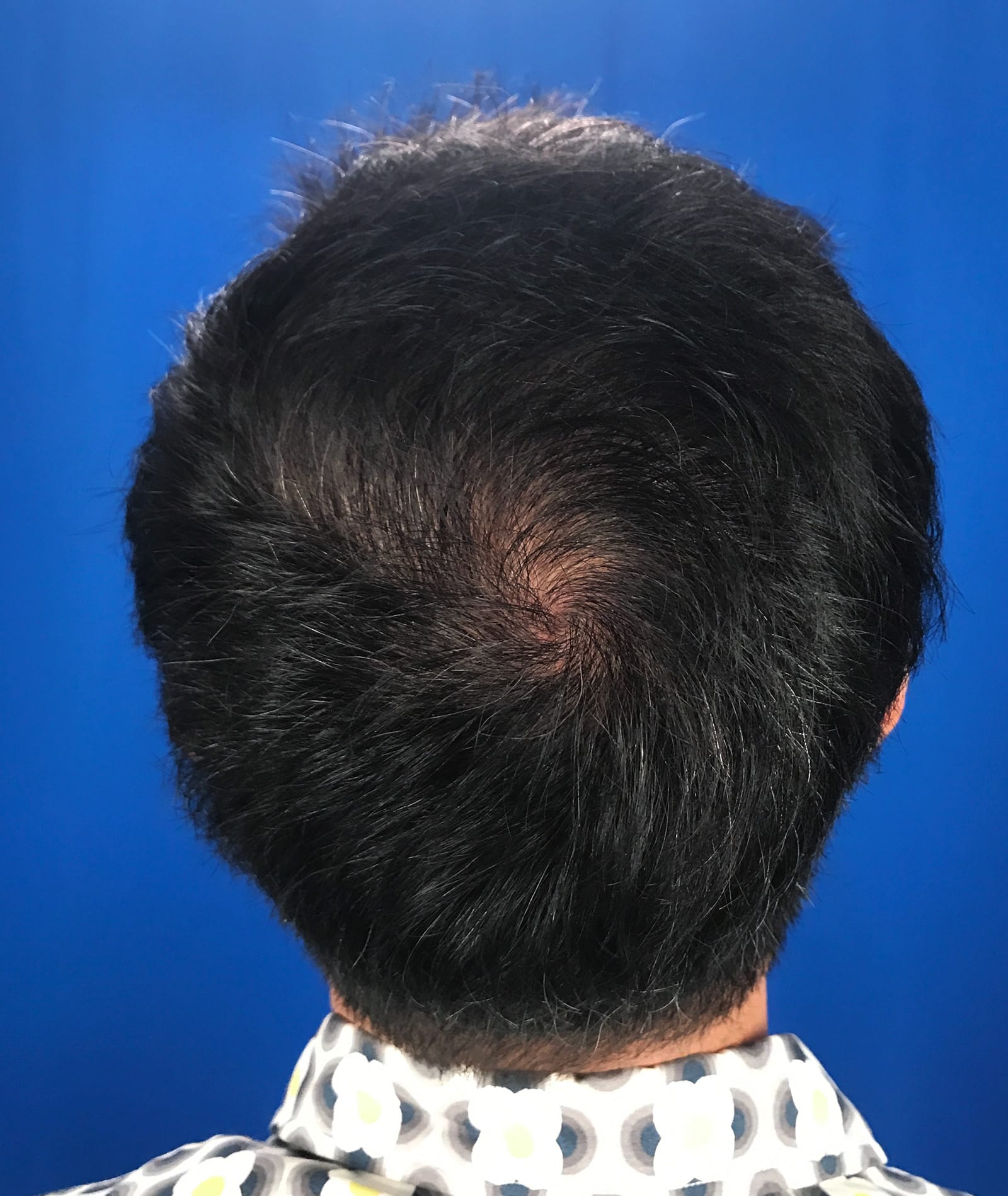 After Image: FUT Strip Graft, 2480 grafts - back