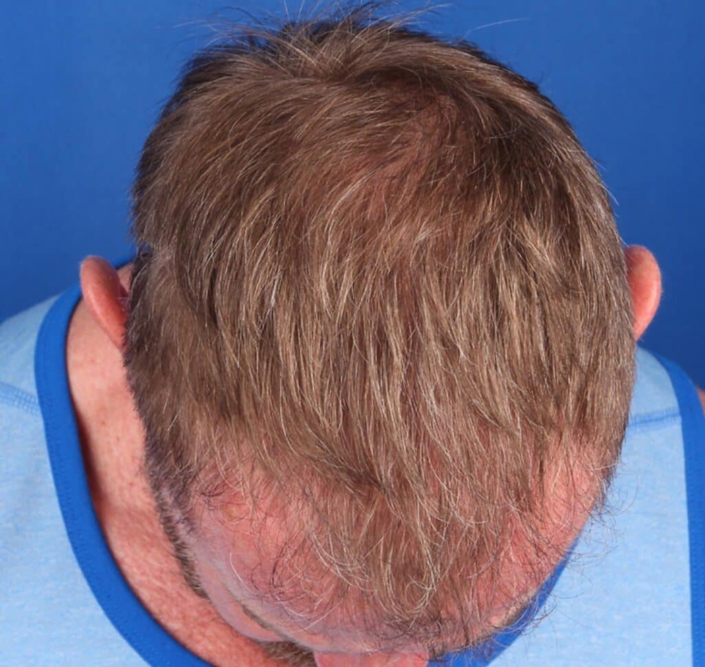 After Image: FUT Strip Graft, 3500 grafts - front