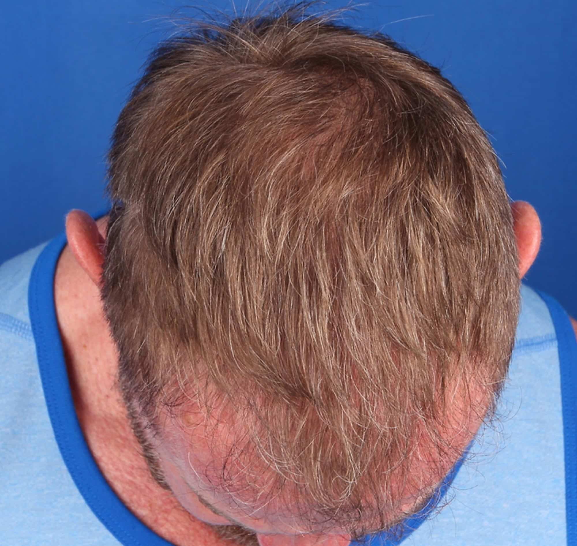After Image: FUT Strip Graft, 3500 grafts - front