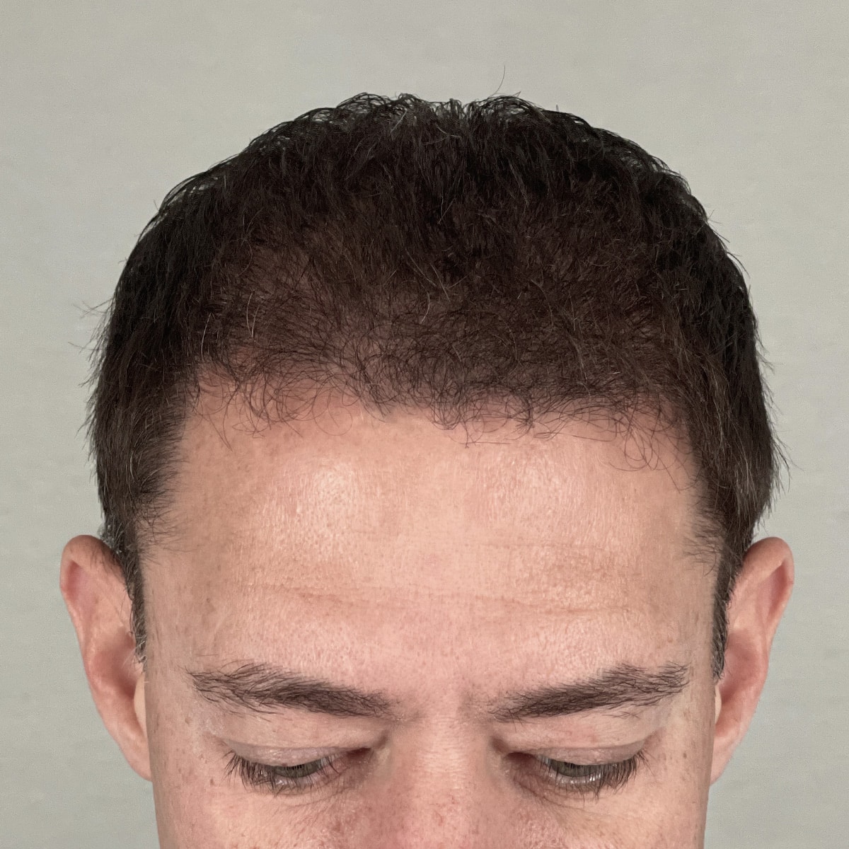After Image: FUE Neograft, 2500 grafts - front