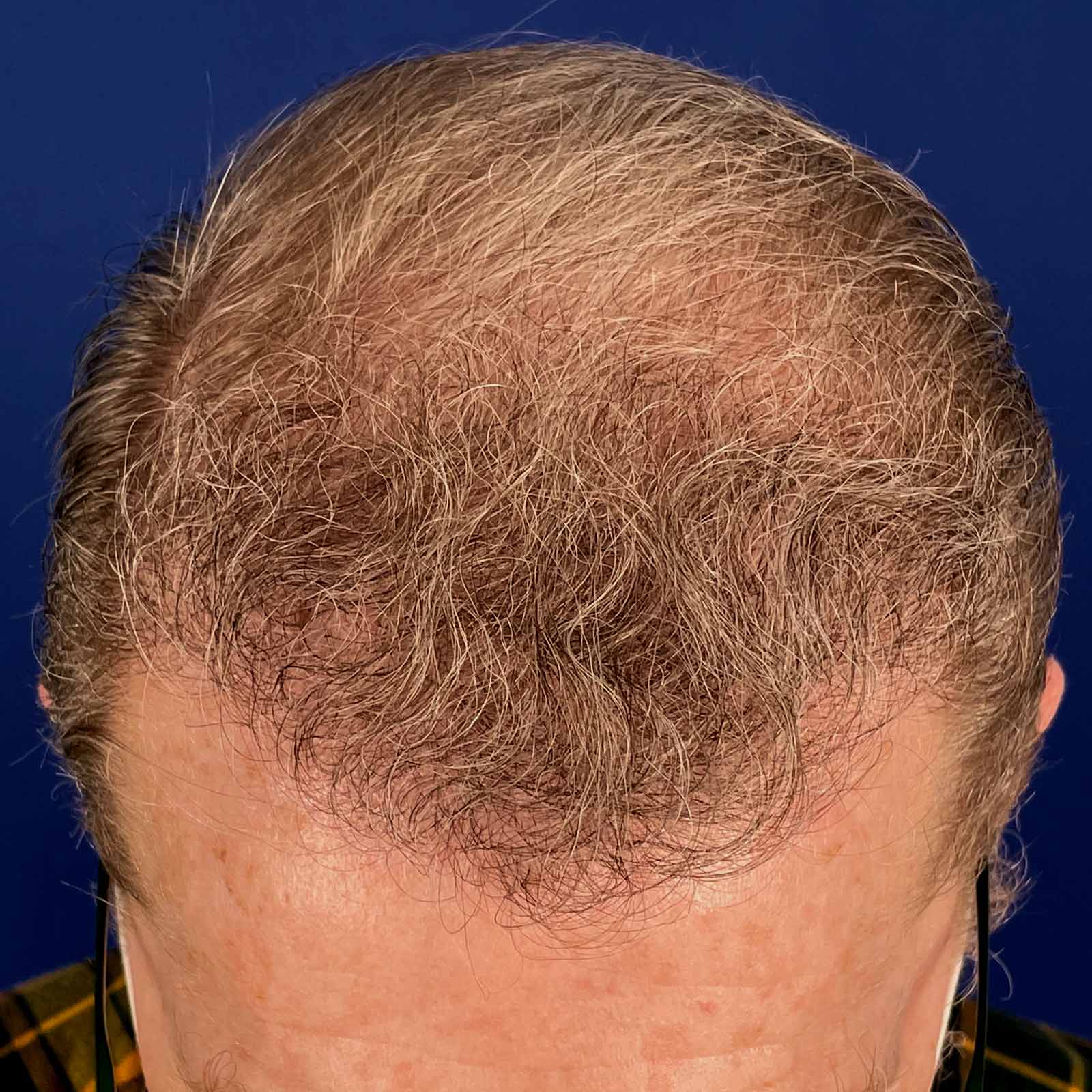After Image: FUE Neograft, 2000 grafts - front