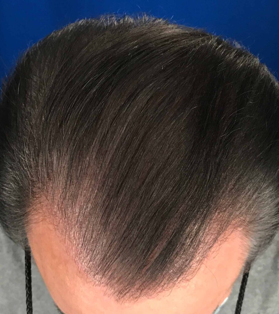 After Image: FUT Strip Graft 1350 grafts - front