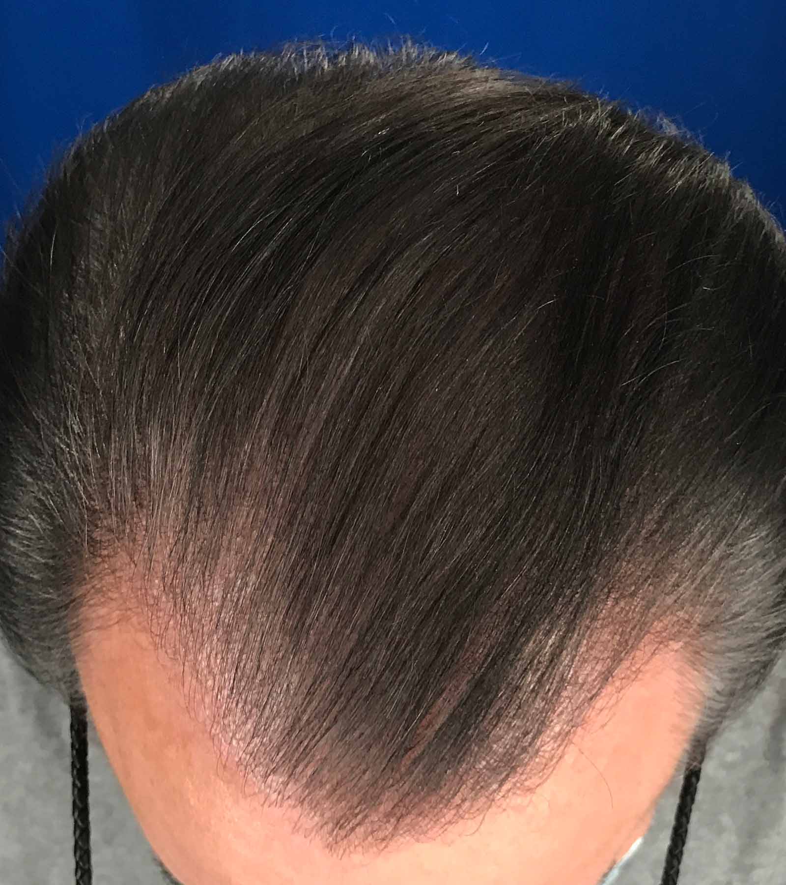 After Image: FUT Strip Graft 1350 grafts - front