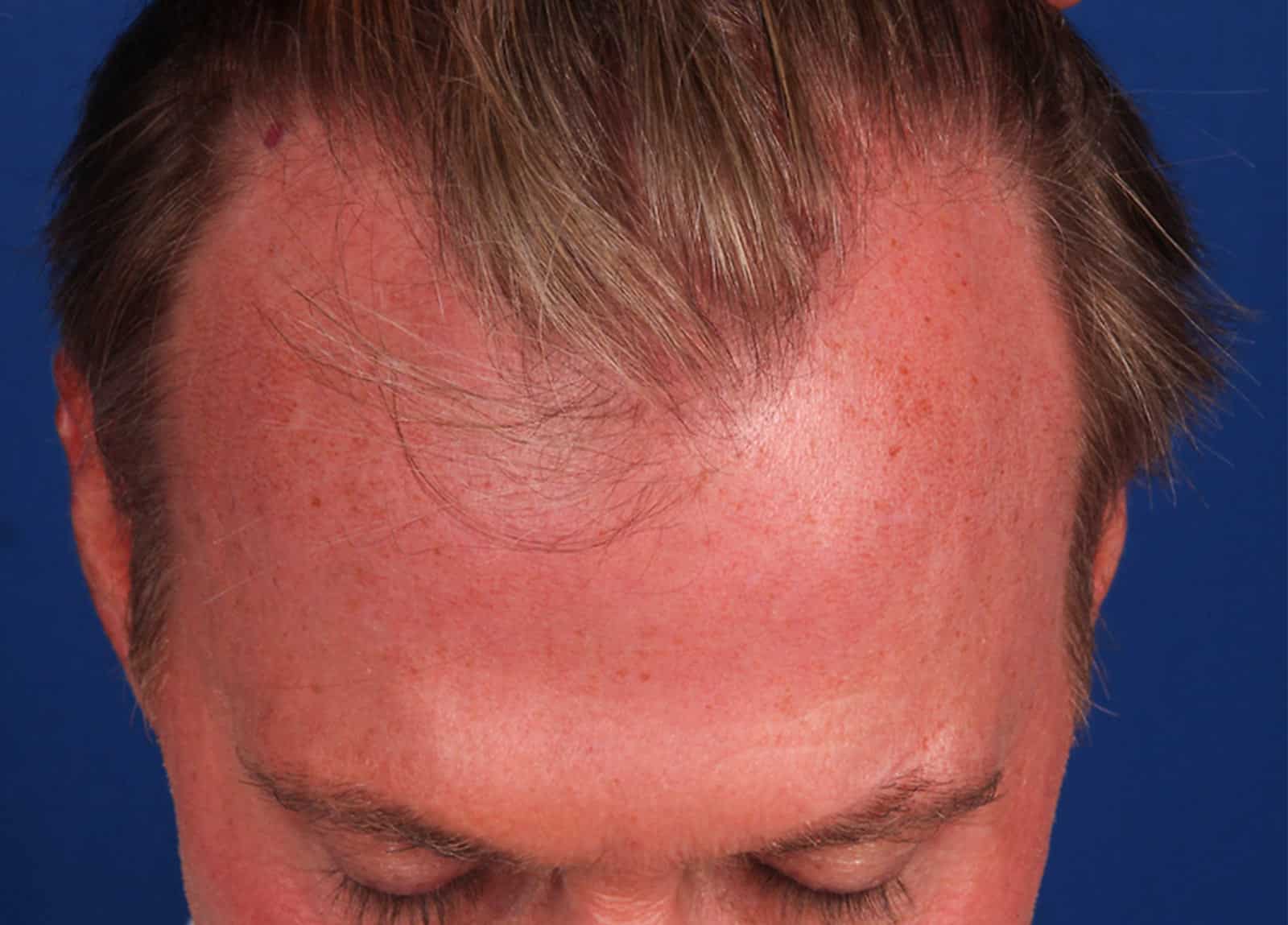 Before Image: FUT Strip Graft, 1944 Grafts - front