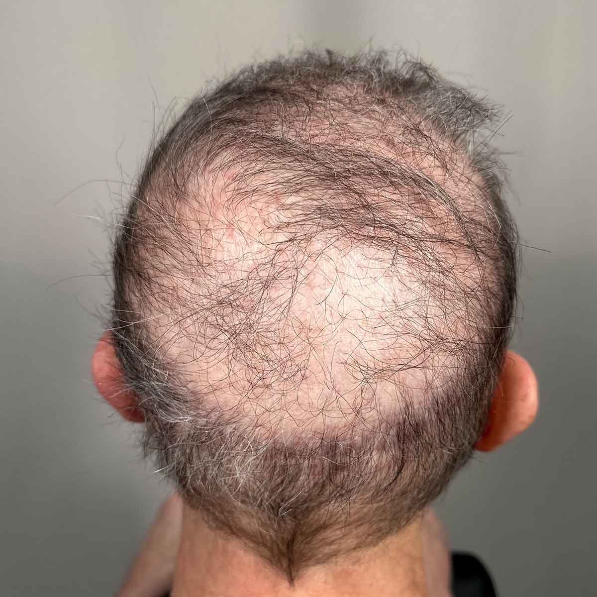 Before Image: FUE Neograft, 500 grafts - back