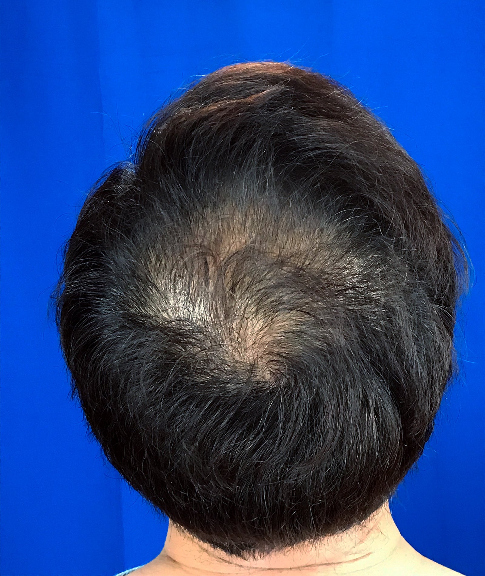 Before Image: FUT Strip Graft, 2480 grafts - back