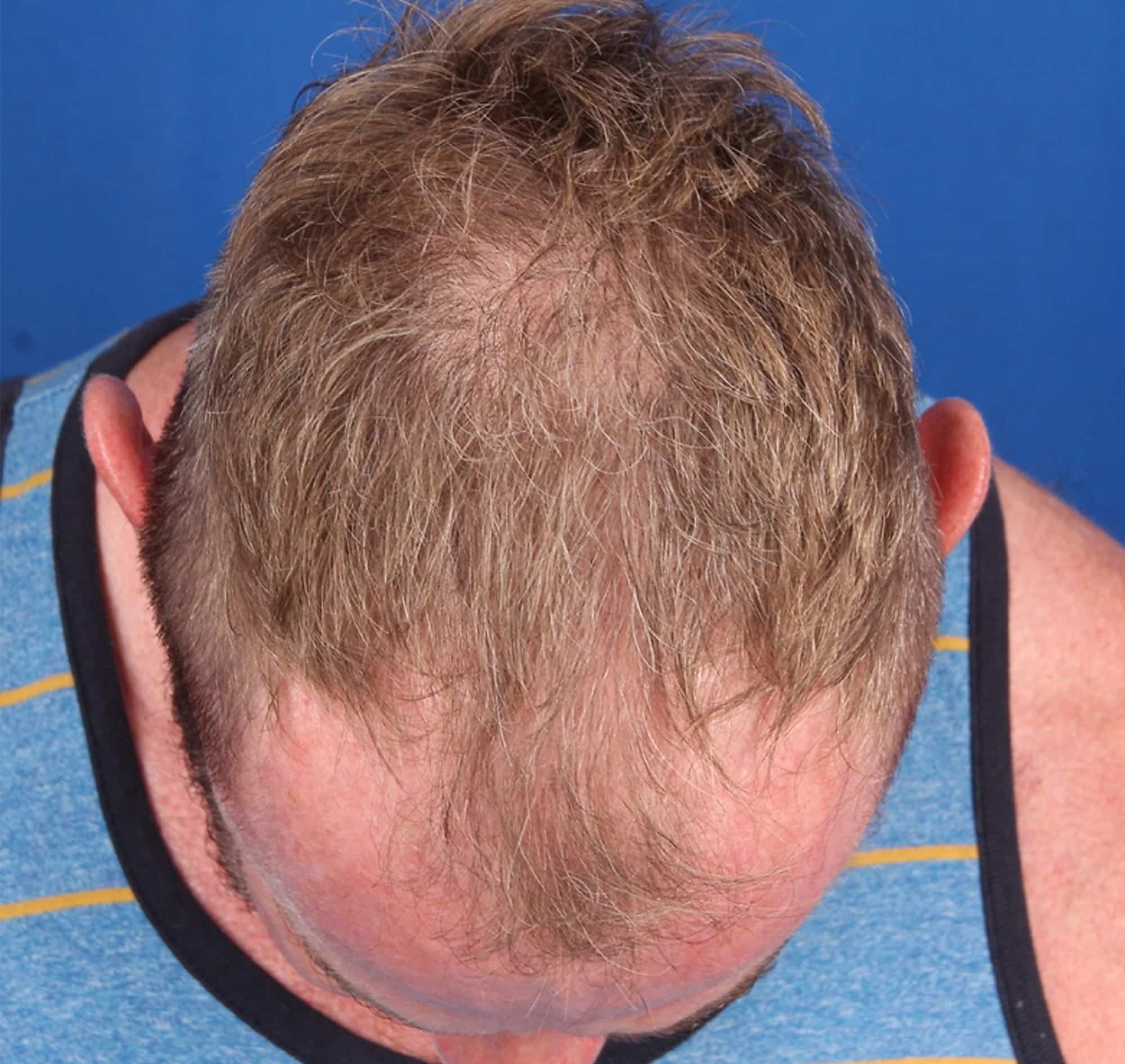 Before Image: FUT Strip Graft, 3500 grafts - front