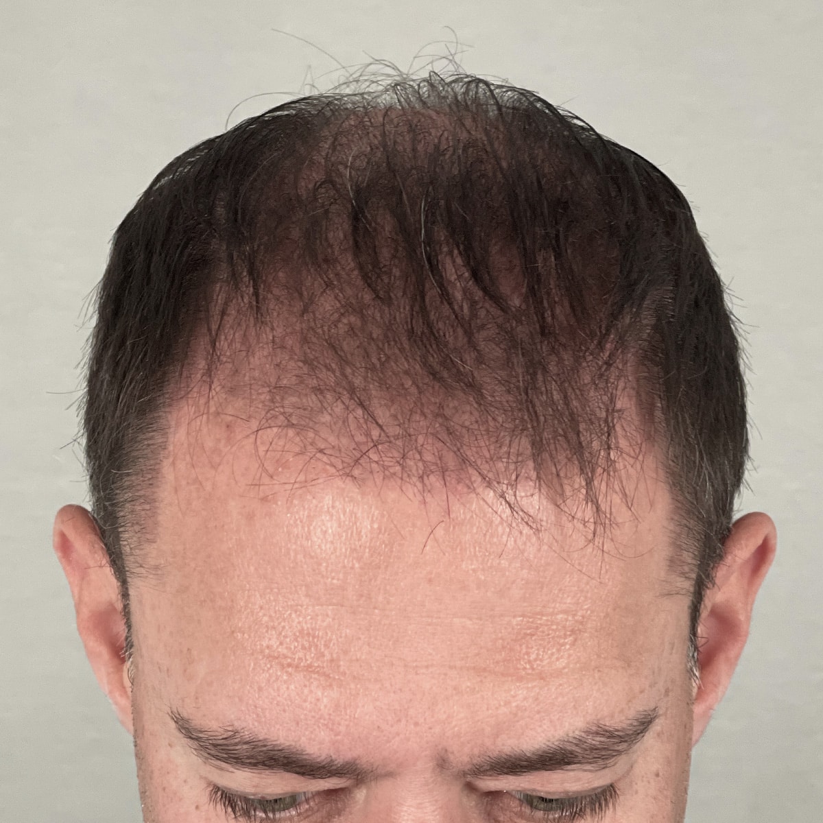 Before Image: FUE Neograft, 2500 grafts - front