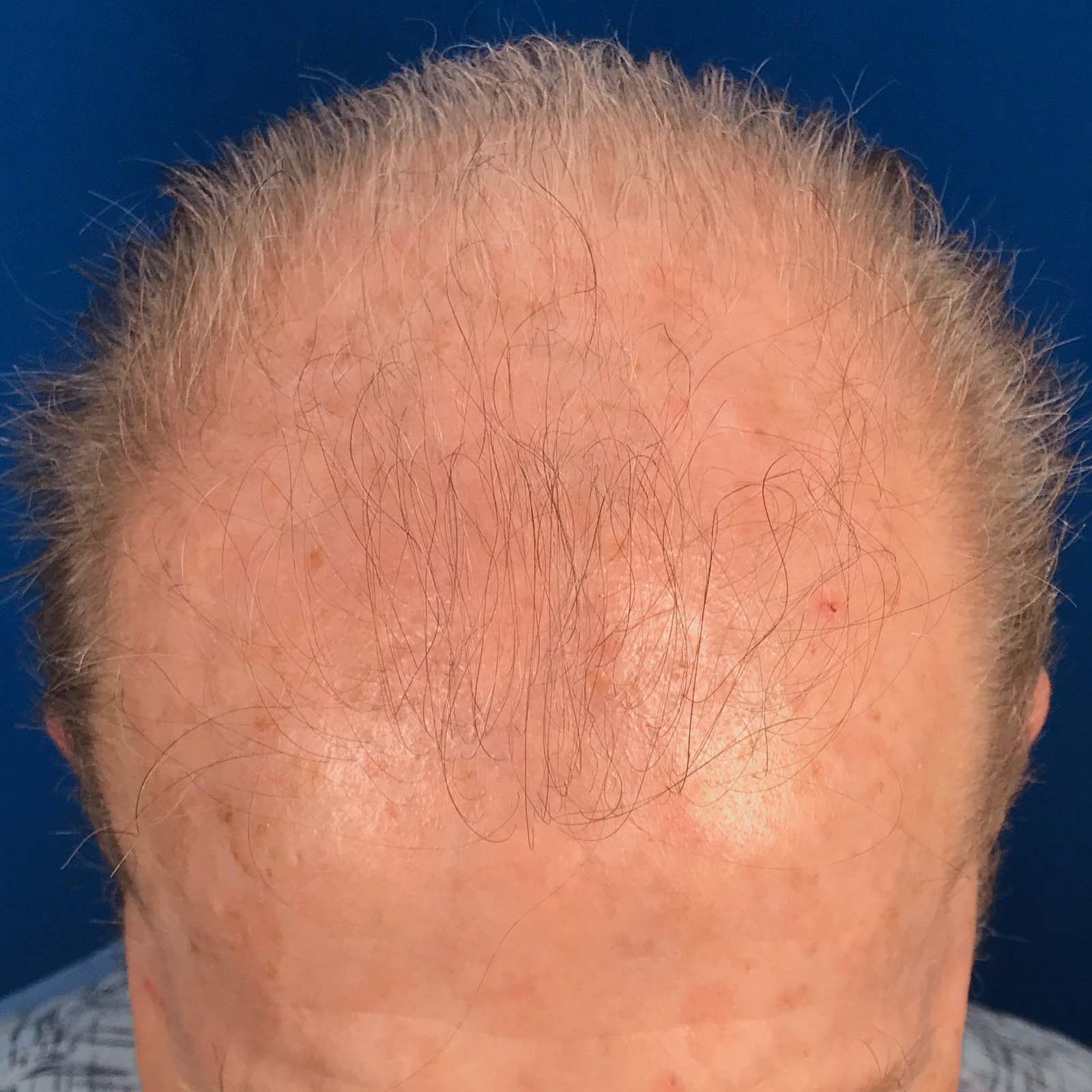 Before Image: FUE Neograft, 2000 grafts - front