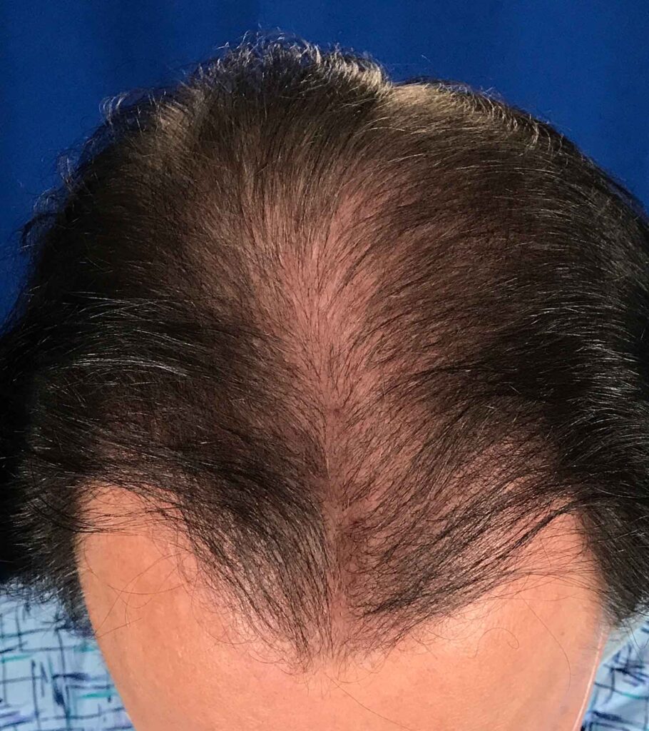 Before Image: FUT Strip Graft 1350 grafts - front