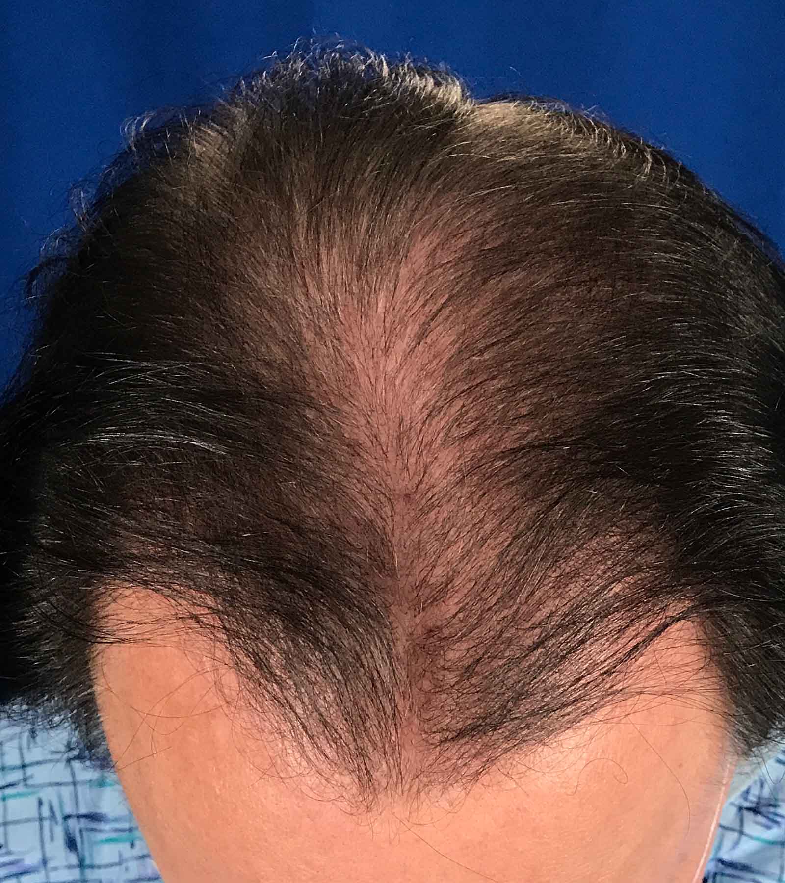 Before Image: FUT Strip Graft 1350 grafts - front