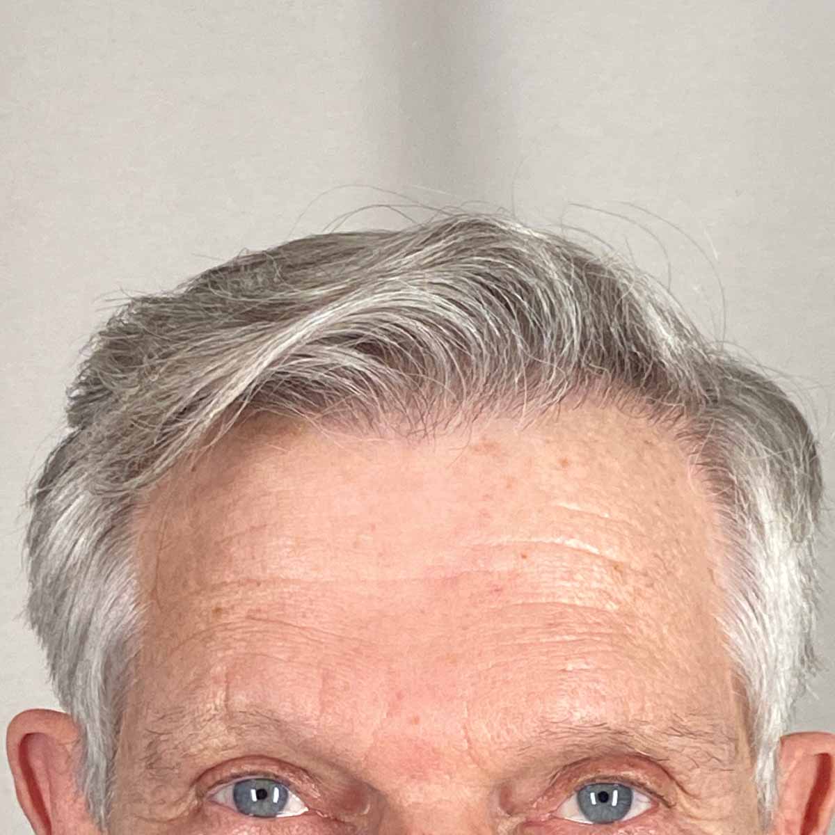 After Image: FUE Neograft, 2000 grafts - front