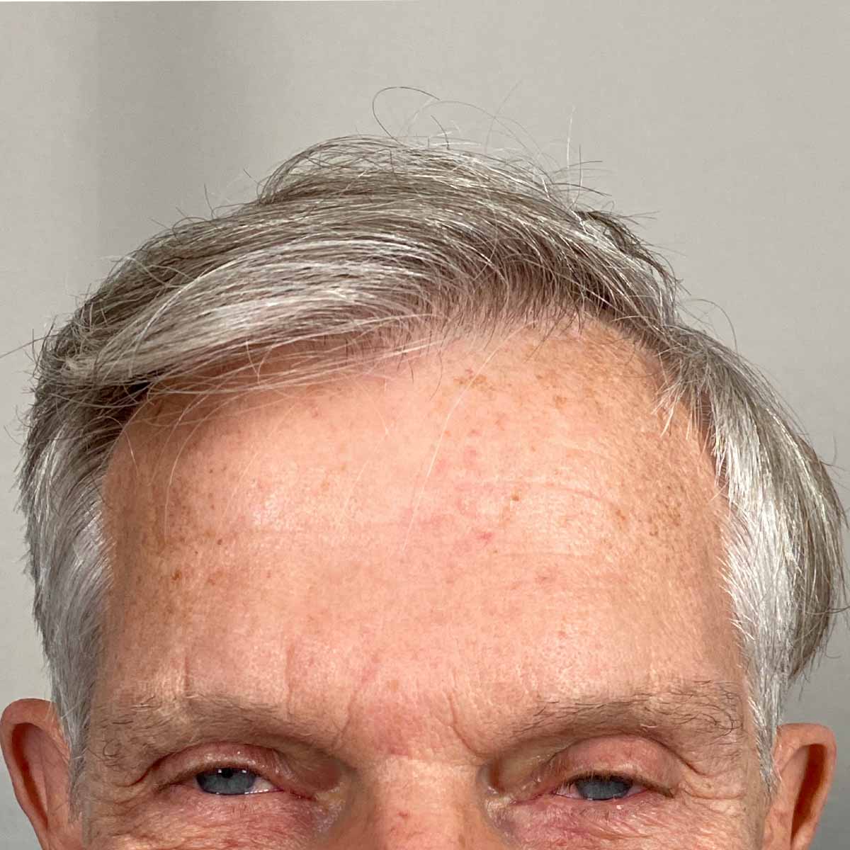 Before Image: FUE Neograft, 2000 grafts - front
