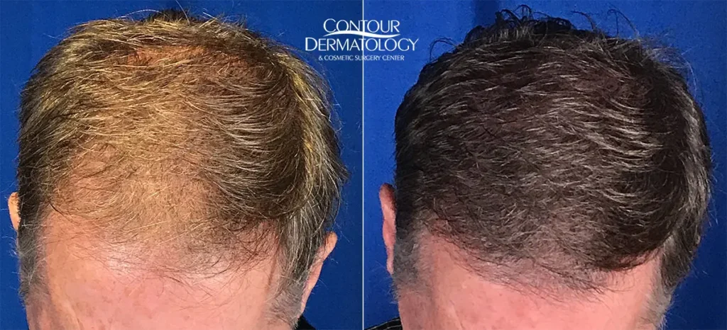 hair-transplant-before-after-10-lg.jpg