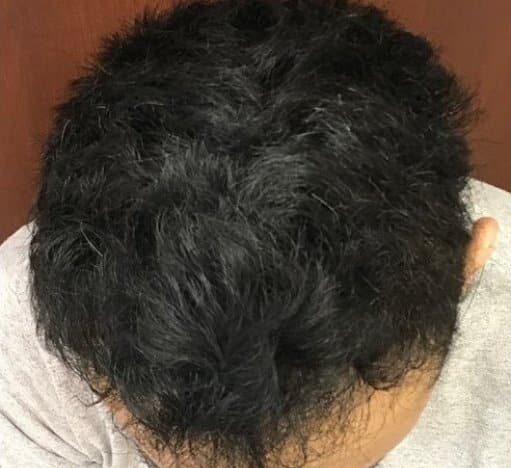 Man with black hair after hair transplant procedure, showing new hair growth.