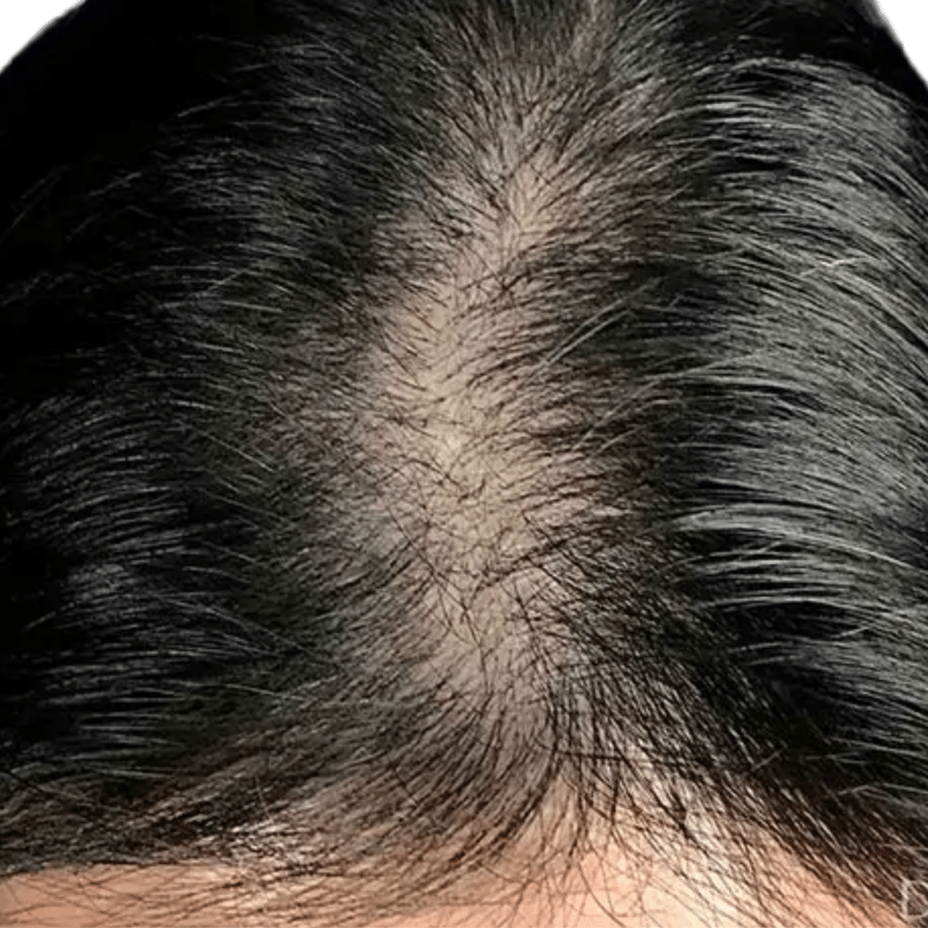 Before Image: Hair Transplant - other