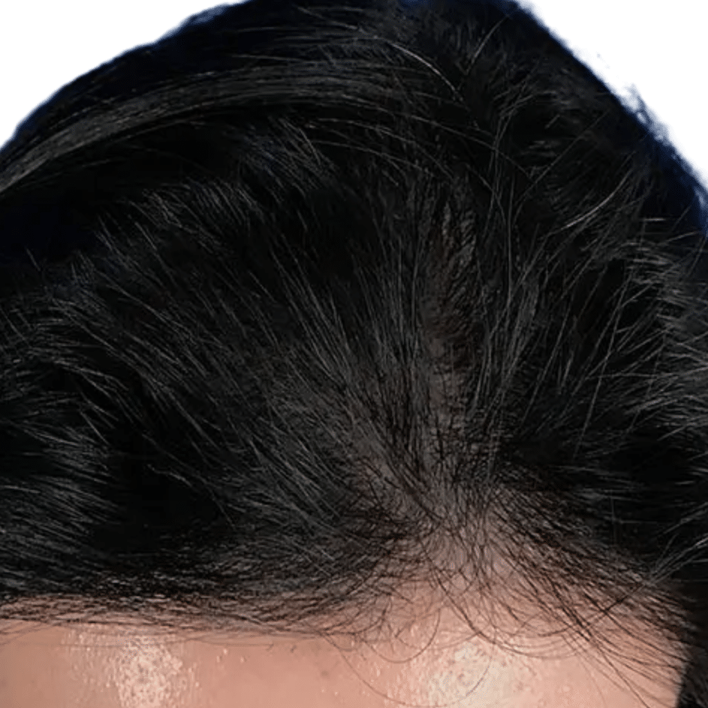 After Image: Hair Transplant - other